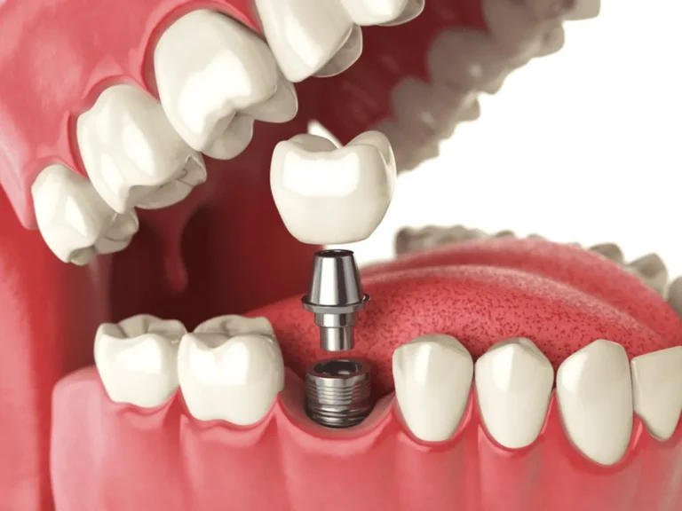 What to Expect When Getting Dental Implants